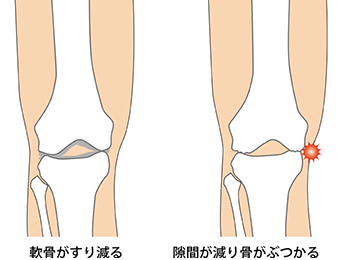knee-img6-1